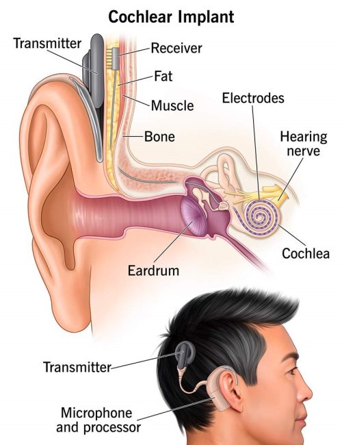 4806-cochlear-implant